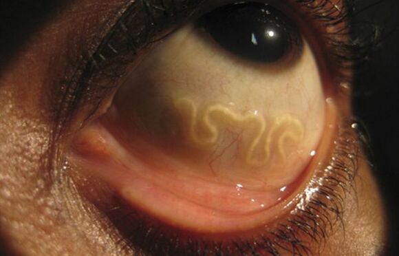 Červ Loa Loa žije v lidském oku a způsobuje slepotu